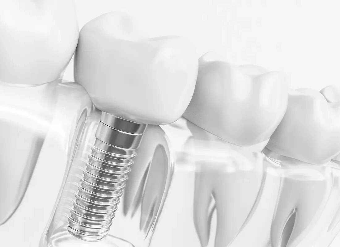 Some Facts About Dentures