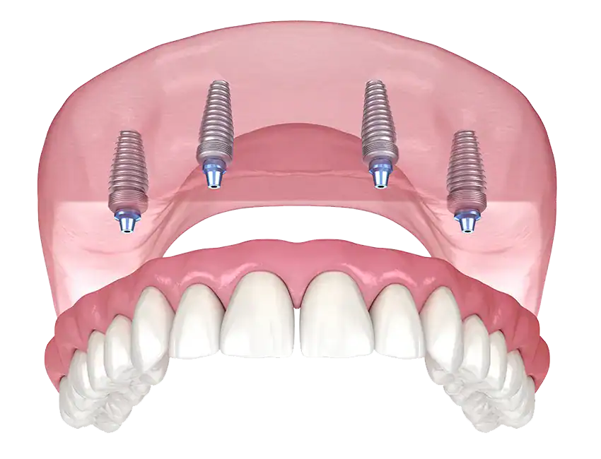 All-on-4 Dental Implants at Marconi Dental Group in Carmichael, CA