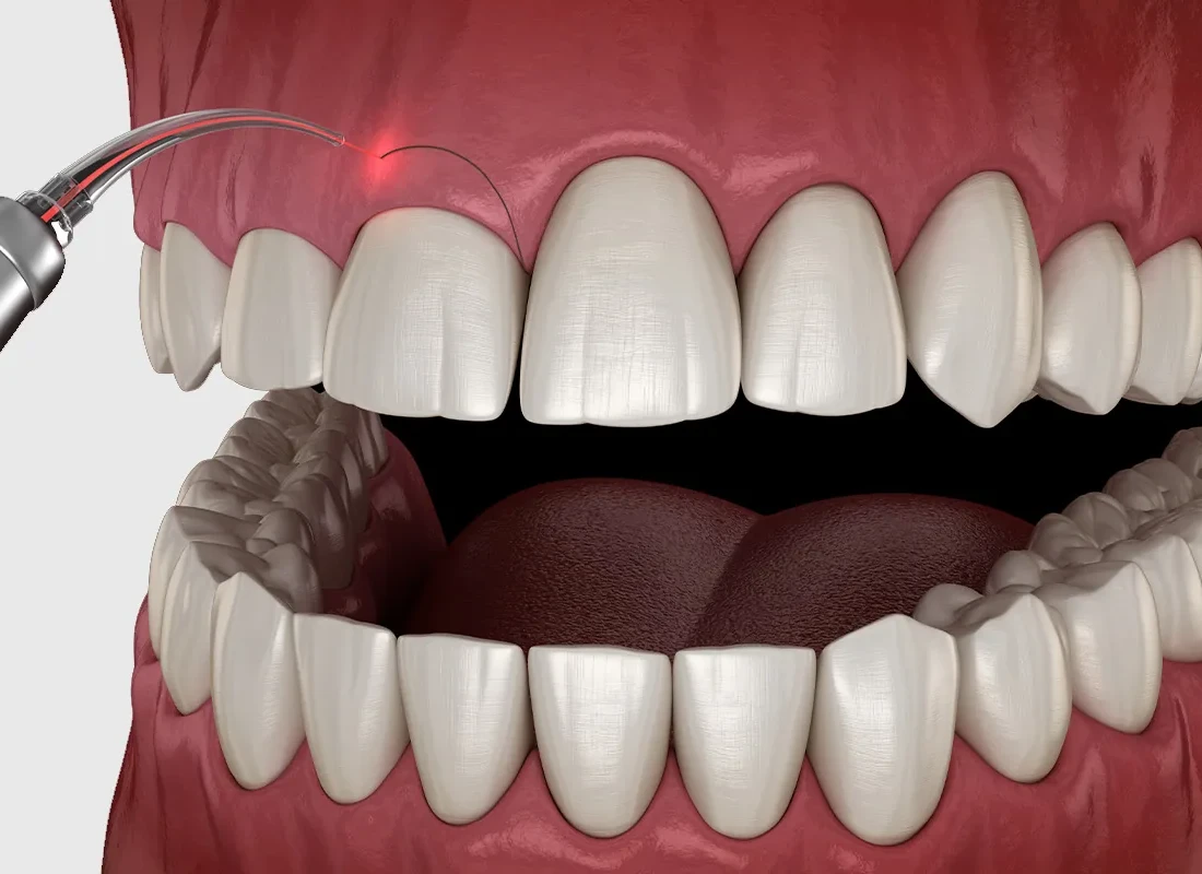 Signs you may need Gum Grafting — Marconi Dental Group