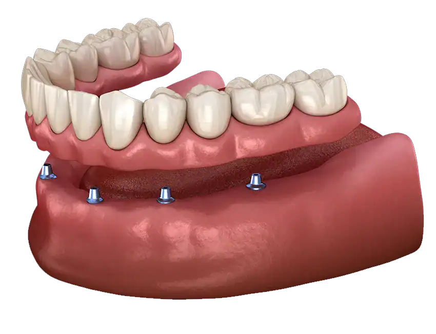 Signs you may need All-on-4 Dental Implants — Marconi Dental Group