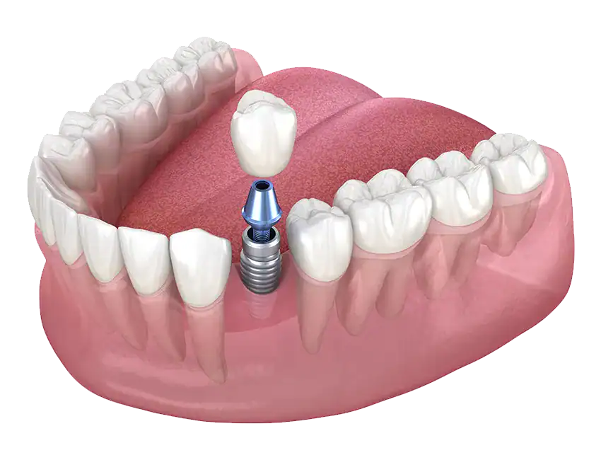 Single dental implant to replace a missing tooth at Marconi Dental Group in Carmichael, CA.