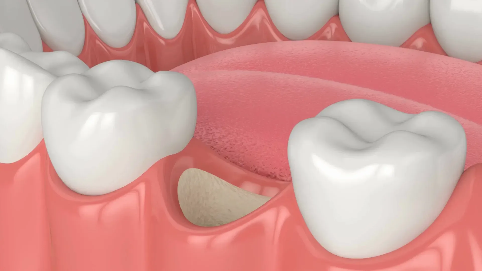 Bone Grafting at Marconi Dental Group in Carmichael, CA