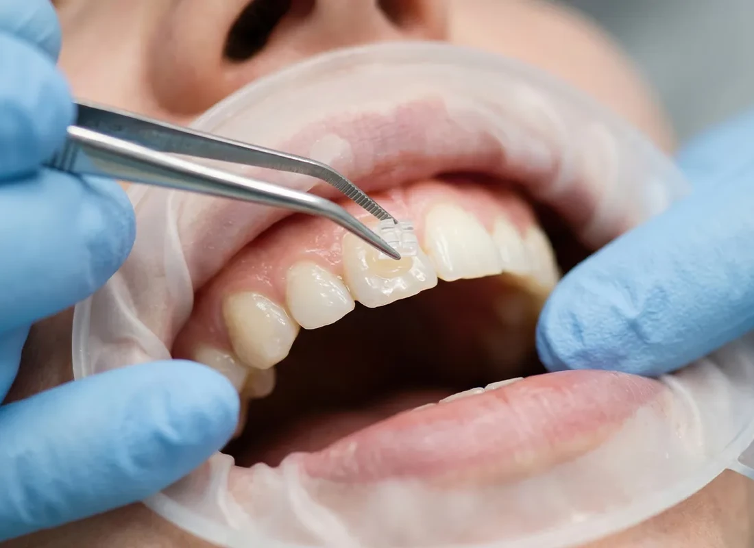 Dental Bonding at Marconi Dental Group in Carmichael, CA