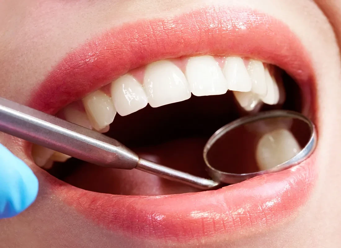Root Canal at Marconi Dental Group in Carmichael, CA