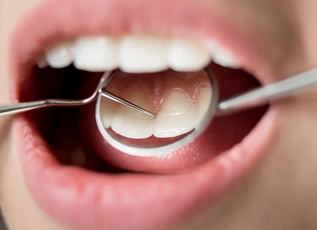 Teeth Cleaning (Prophy) at Marconi Dental Group in Carmichael, CA