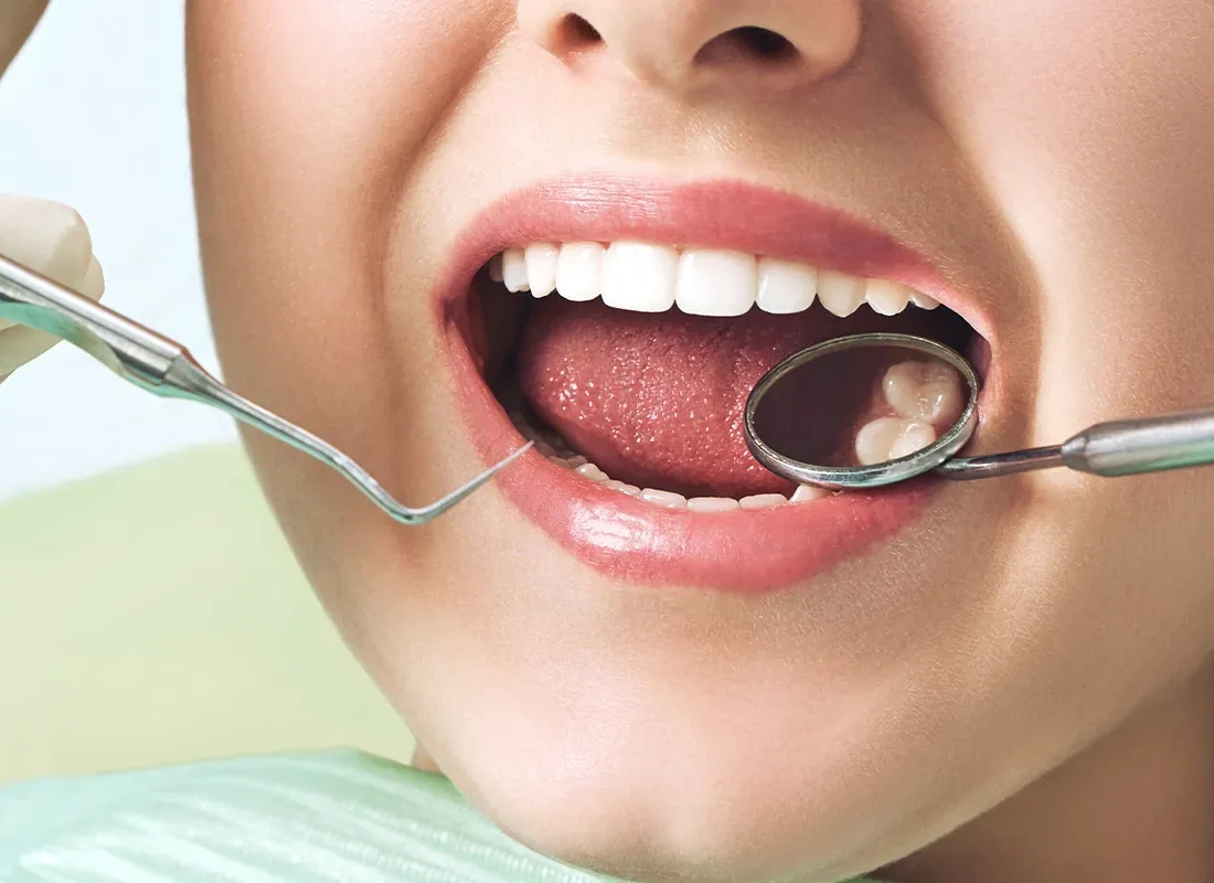 Tooth-Colored Fillings at Marconi Dental Group in Carmichael, CA