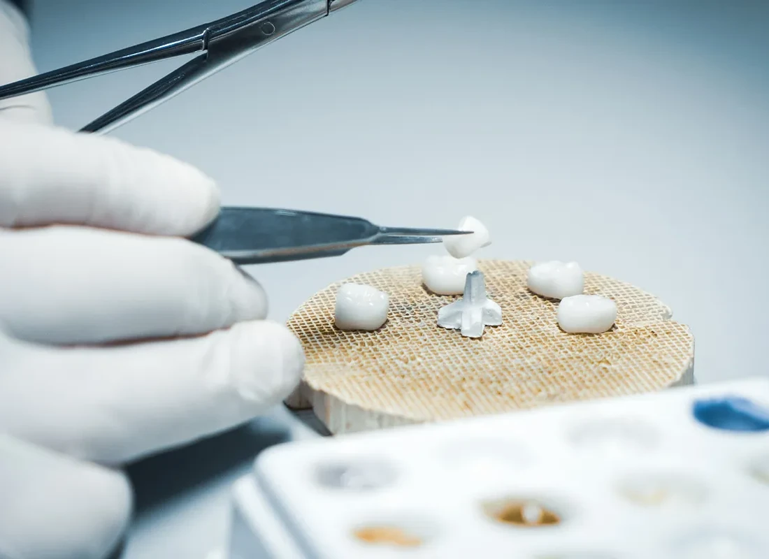 Signs you may need Dental Crowns — Marconi Dental Group