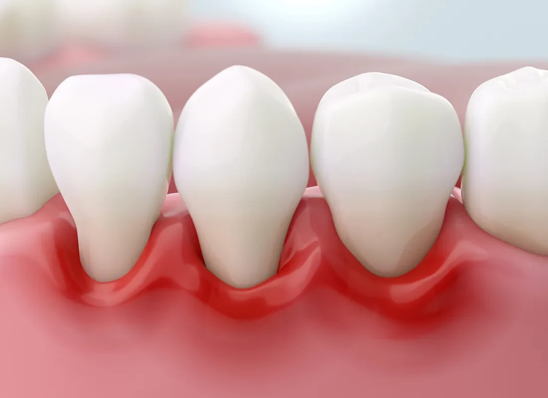 Gum Grafting at Marconi Dental Group in Carmichael, CA