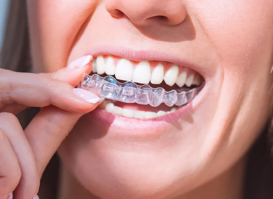 Should You Wear a Mouthguard?
