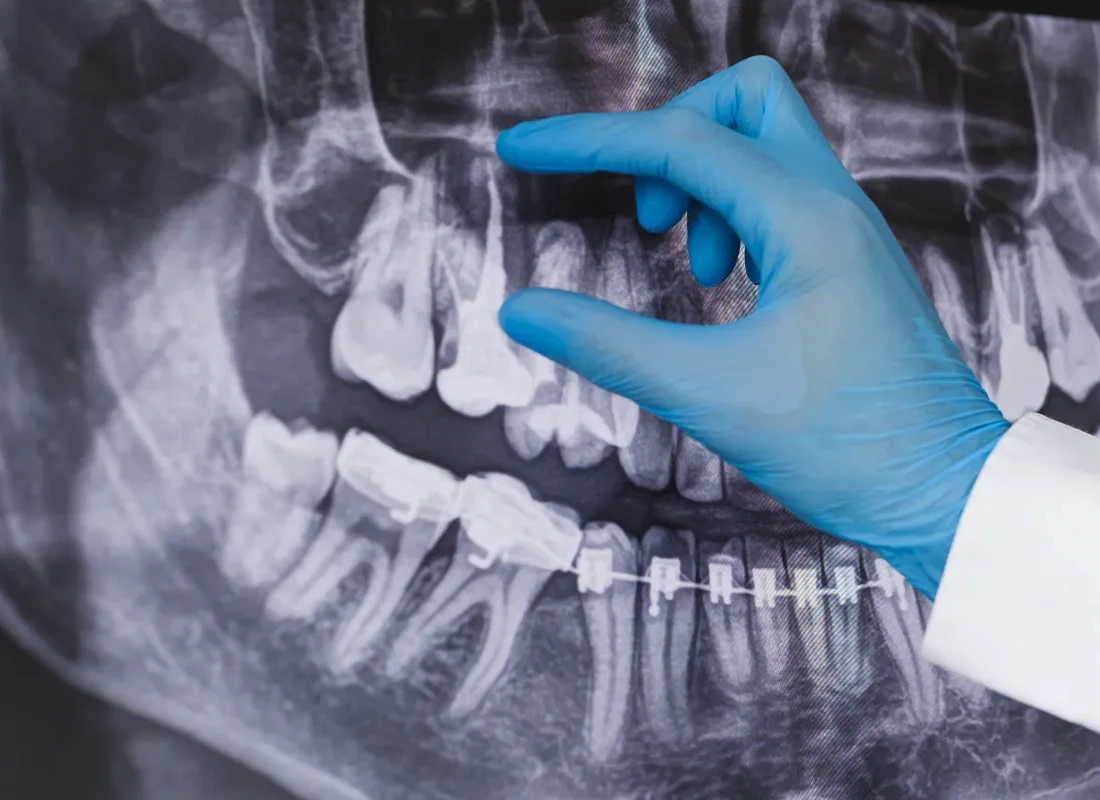 Signs you may need Root Canal — Marconi Dental Group