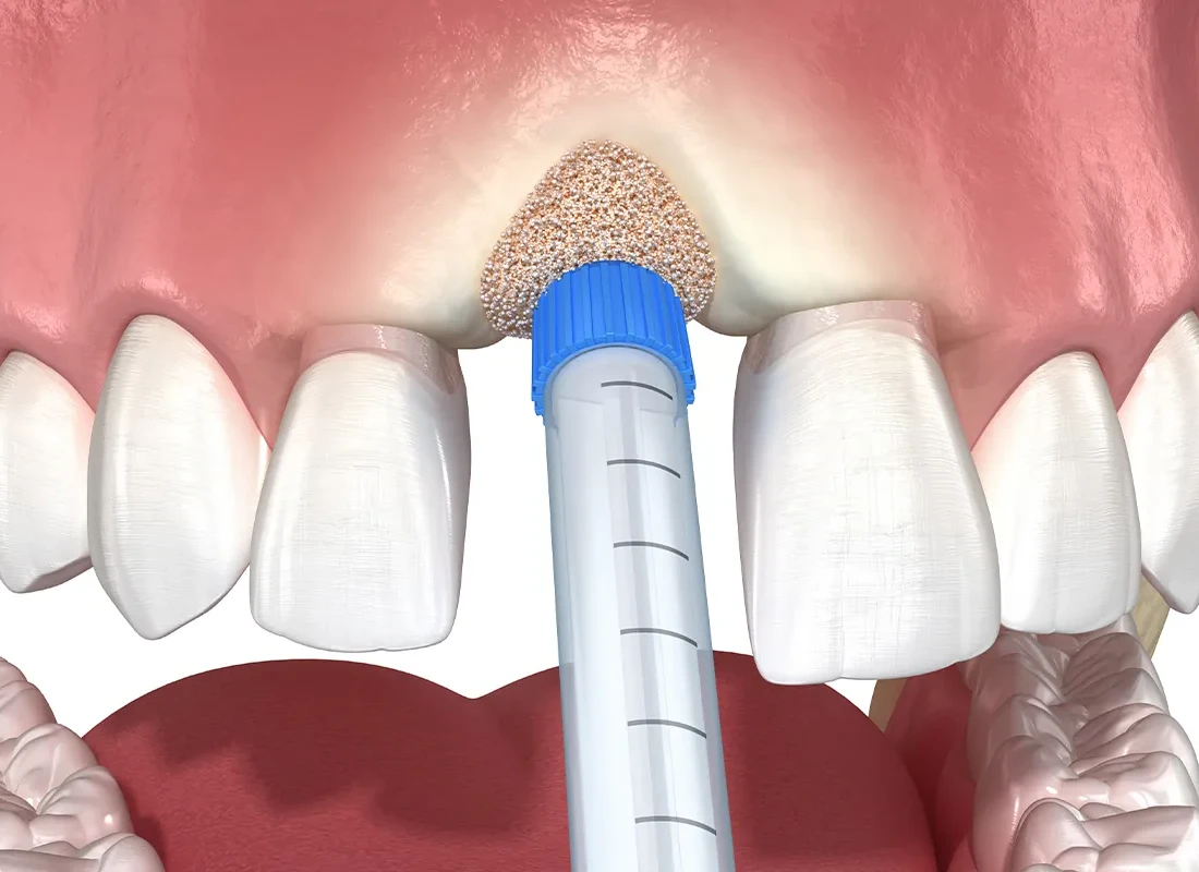 Sinus Lifts at Marconi Dental Group in Carmichael, CA