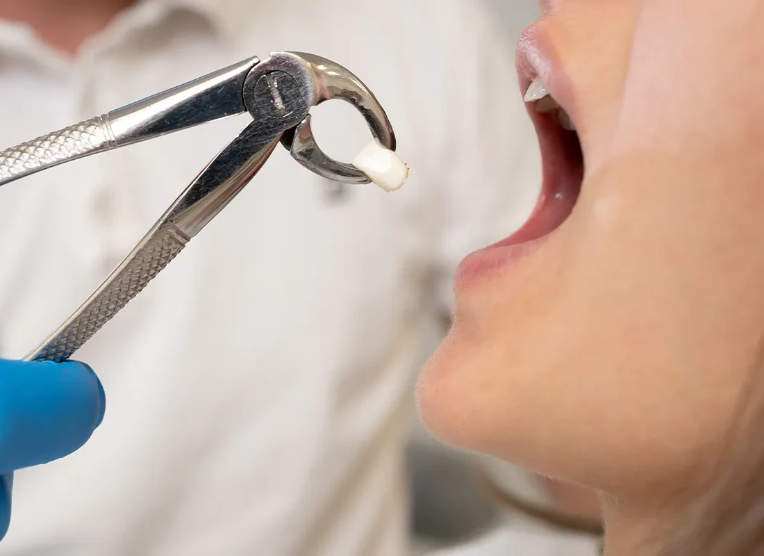 Teeth Extraction at Marconi Dental Group in Carmichael, CA