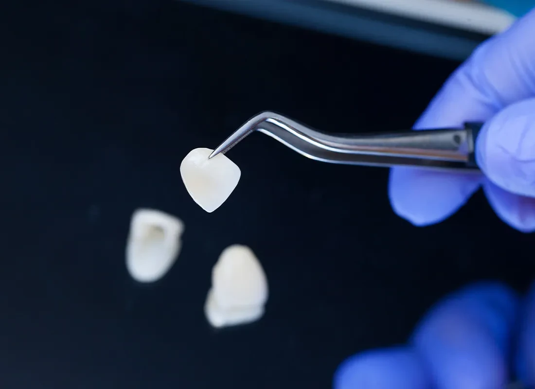Signs you may need Veneers — Marconi Dental Group