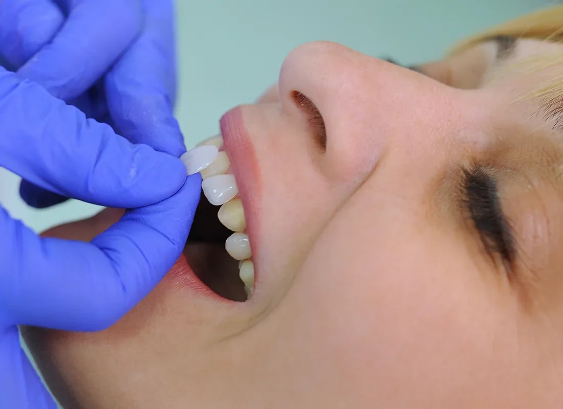 Veneers at Marconi Dental Group in Carmichael, CA