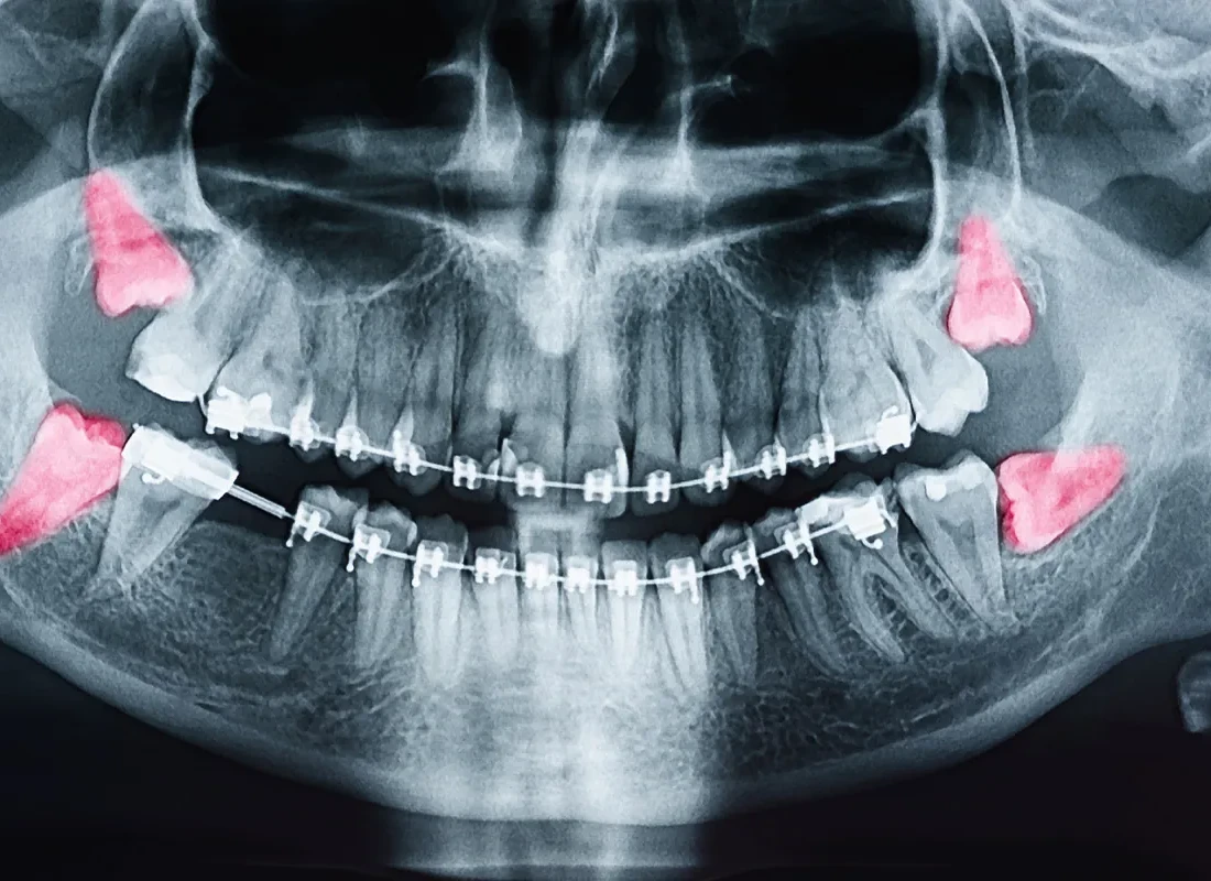 Wisdom Teeth Removal at Marconi Dental Group in Carmichael, CA